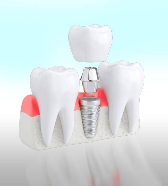 Pura Vida Dental Implants 01